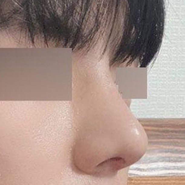 鼻炎手術兼、自己管理も兼ねて手術することになりました