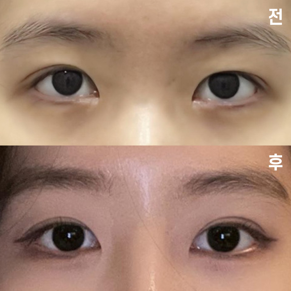 ウィーバース美容外科で手術して1ヶ月になりました~! 