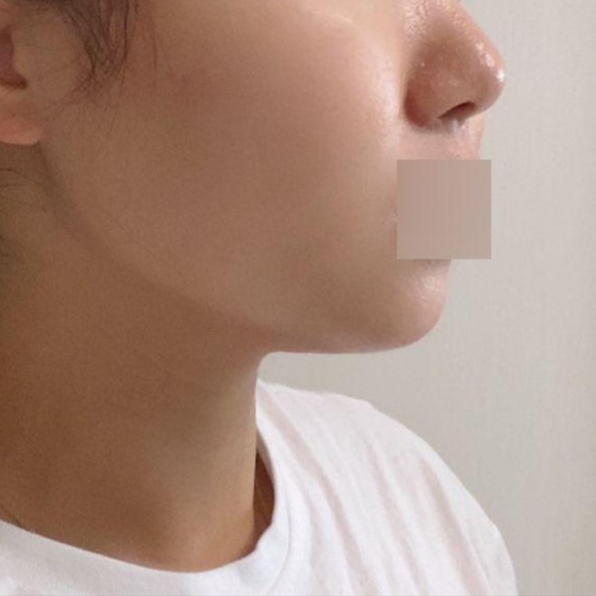 1週間目より顎のラインがシャープになったのが分かりますよね（笑）