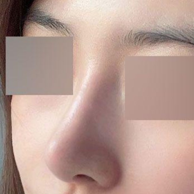 鼻の再手術後、問題なく3ヶ月経過しました（笑）