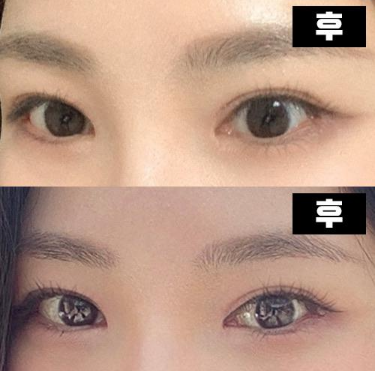 二重手術で悩んでいるなら本当におすすめします～