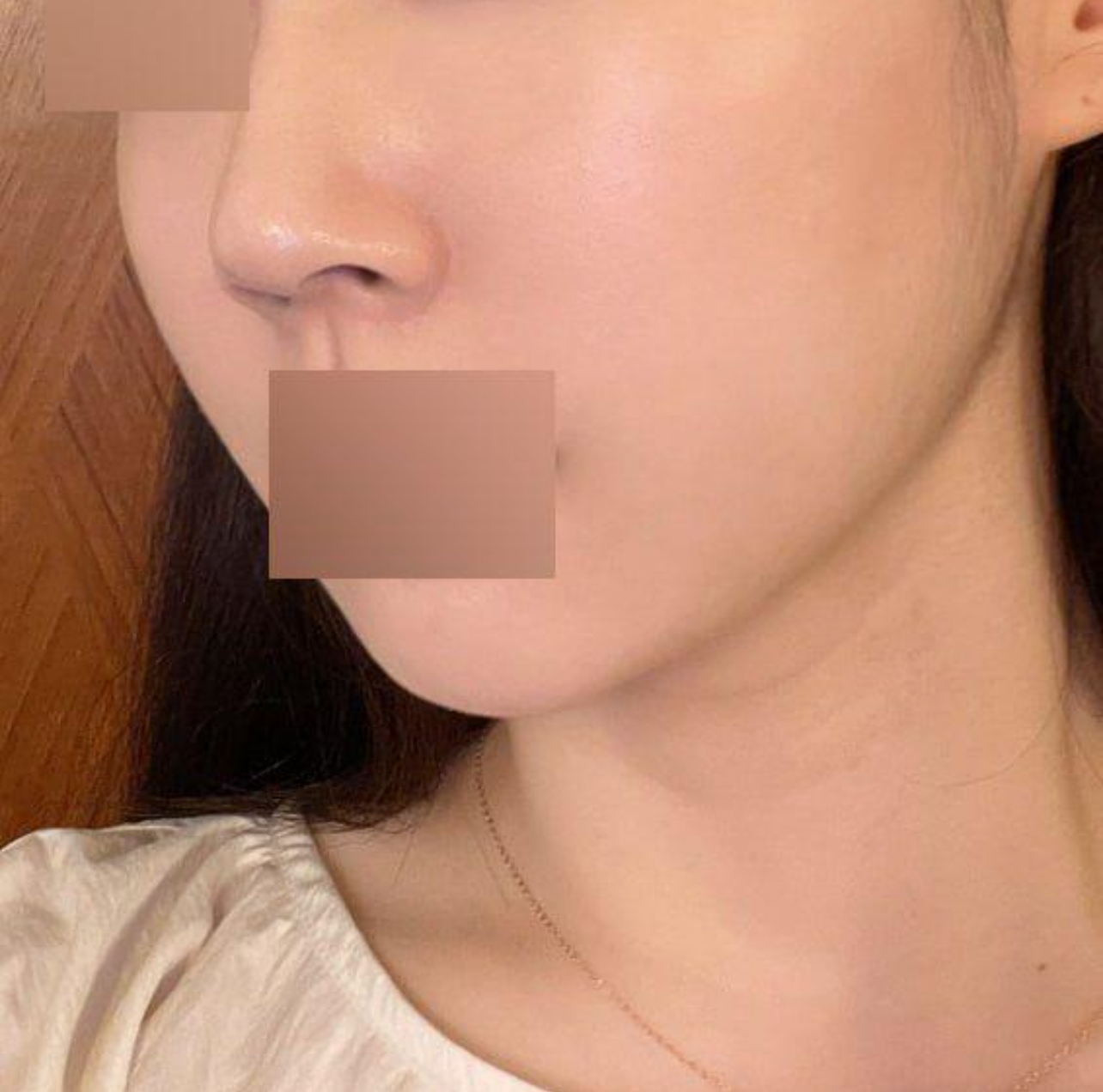 顔のラインがすっきりして、数年若く見えます。嬉しいです。