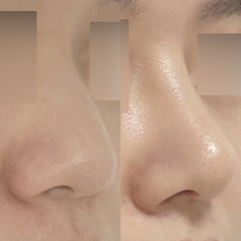 団子鼻にプロテーゼなしの手術を受けました