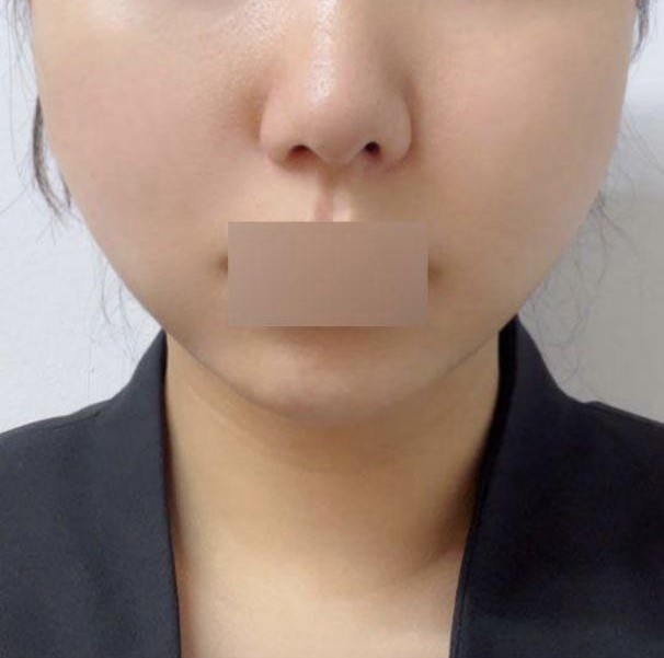 糸リフティングを受けて本当に良かった