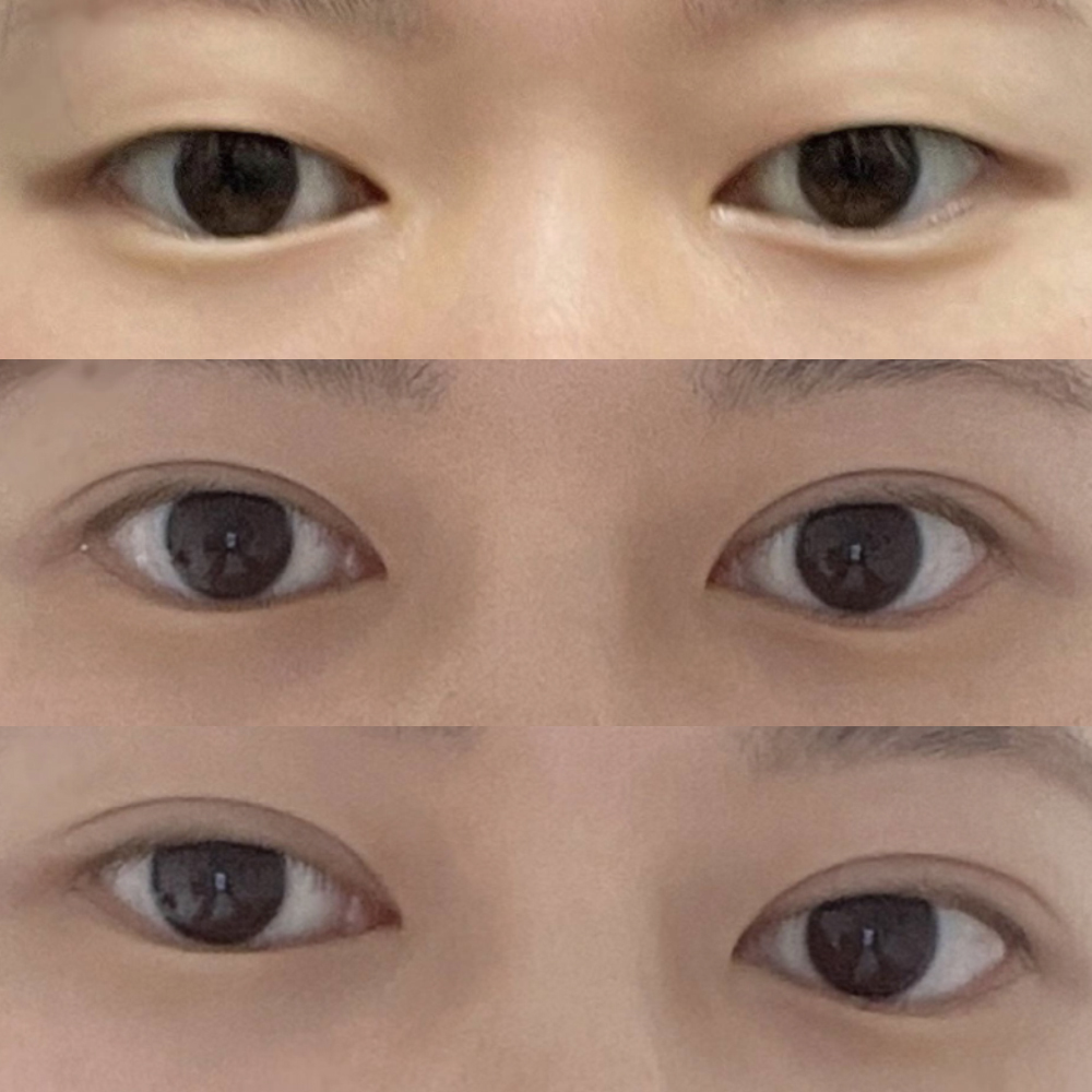 切開で細いラインに成功しました