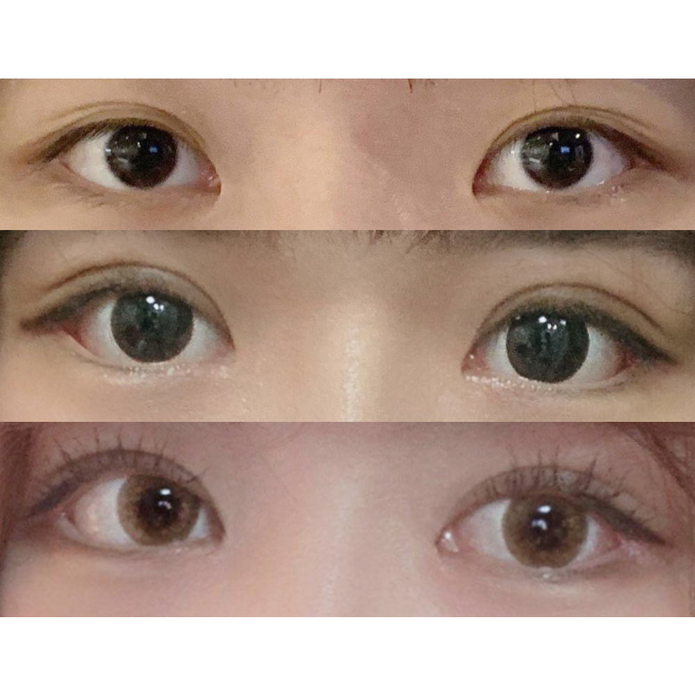 目尻切開＋自然癒着＋目つき矯正レビュー！