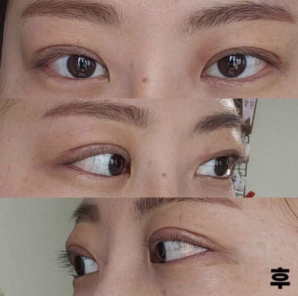 手術して本当によかったと思います