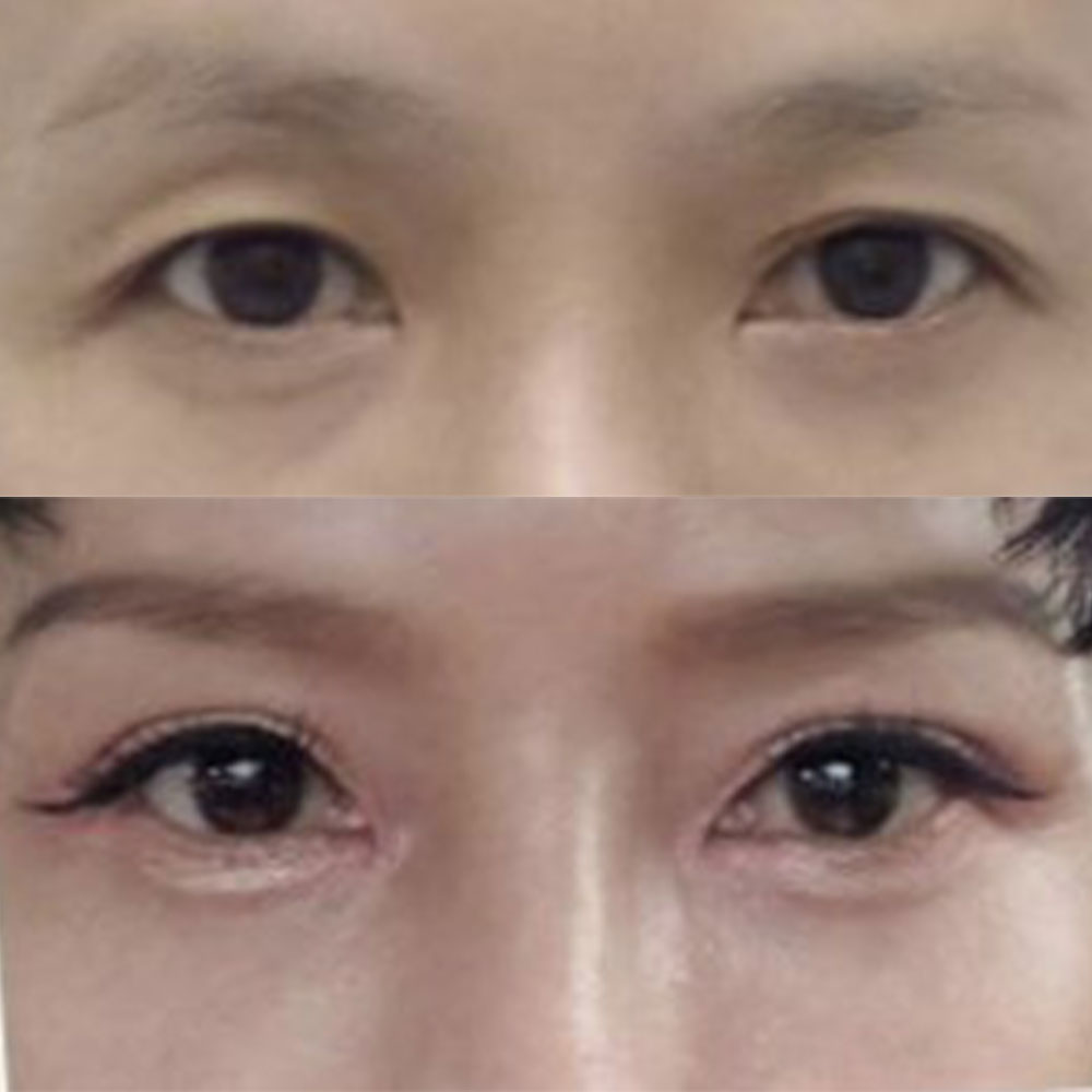 腫れもすぐに引いて、うまくいったようです