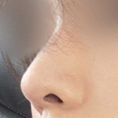 鼻整形をしたと思わなかったと言われるほど自然だと言われます。