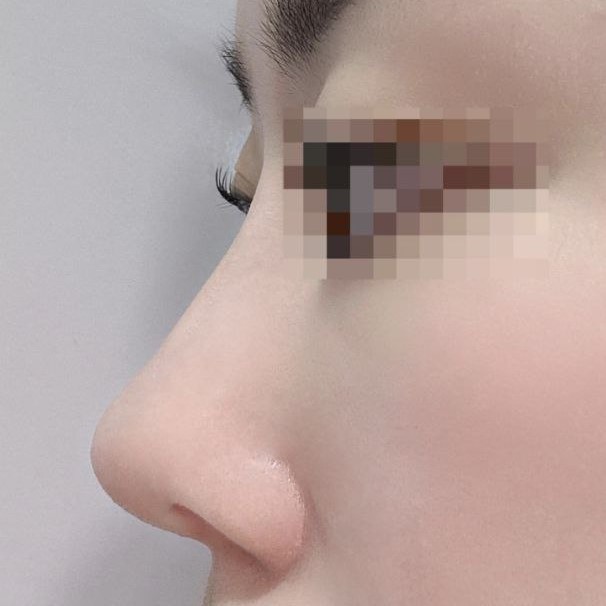 気に入っています！一ヶ月後の腫れが引いた時がとても楽しみです！