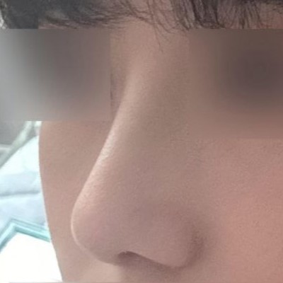 初めての鼻整形手術にもかかわらず、とてもとても3728299393829%満足しています