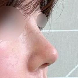 私も手術前後の写真の違いにマジでびっくりしました（笑）