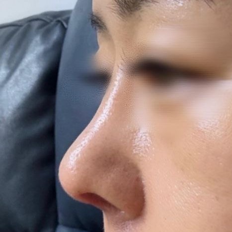 鼻先が垂れ下がっているのが悩みでしたが、鼻先ができてとても嬉しいです^^