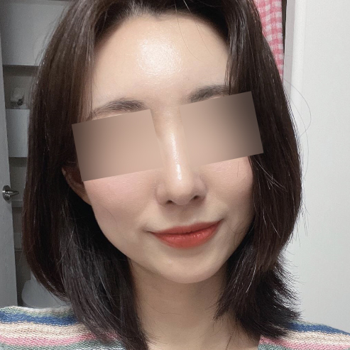 鼻+額に自家脂肪移植を受けました!!