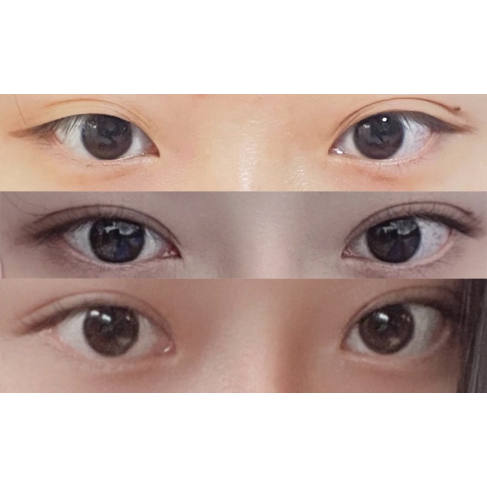 目と鼻の手術を受けましたㅎㅎ