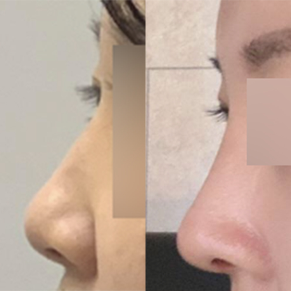 初めての鼻の手術を受けました！