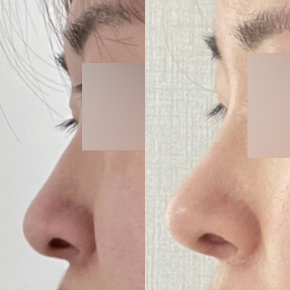 長年のコンプレックスだった鼻、ついに手術しました〜