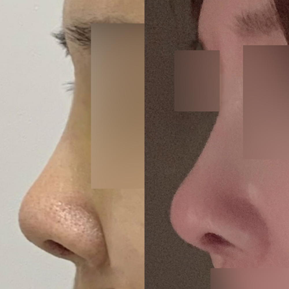 5年前に突然鼻の手術をしました:-)))