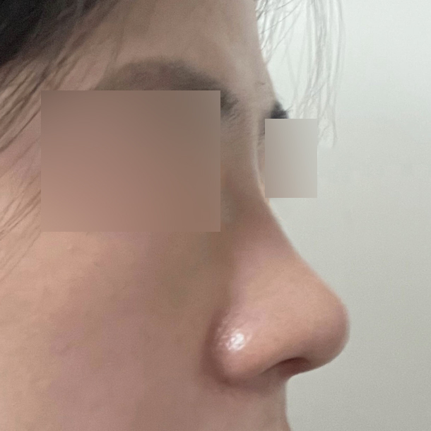 団子鼻の手術を受けました