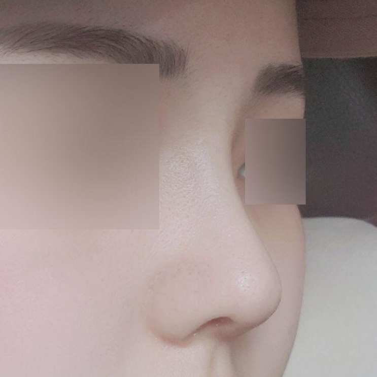 鼻の手術から1ヶ月