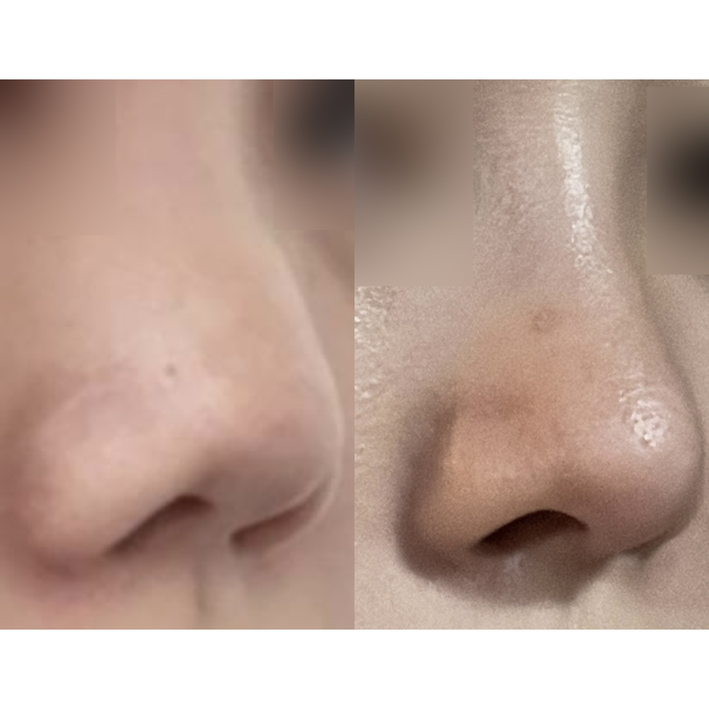 鼻の手術を受けてから1ヶ月ちょっと経ちました！