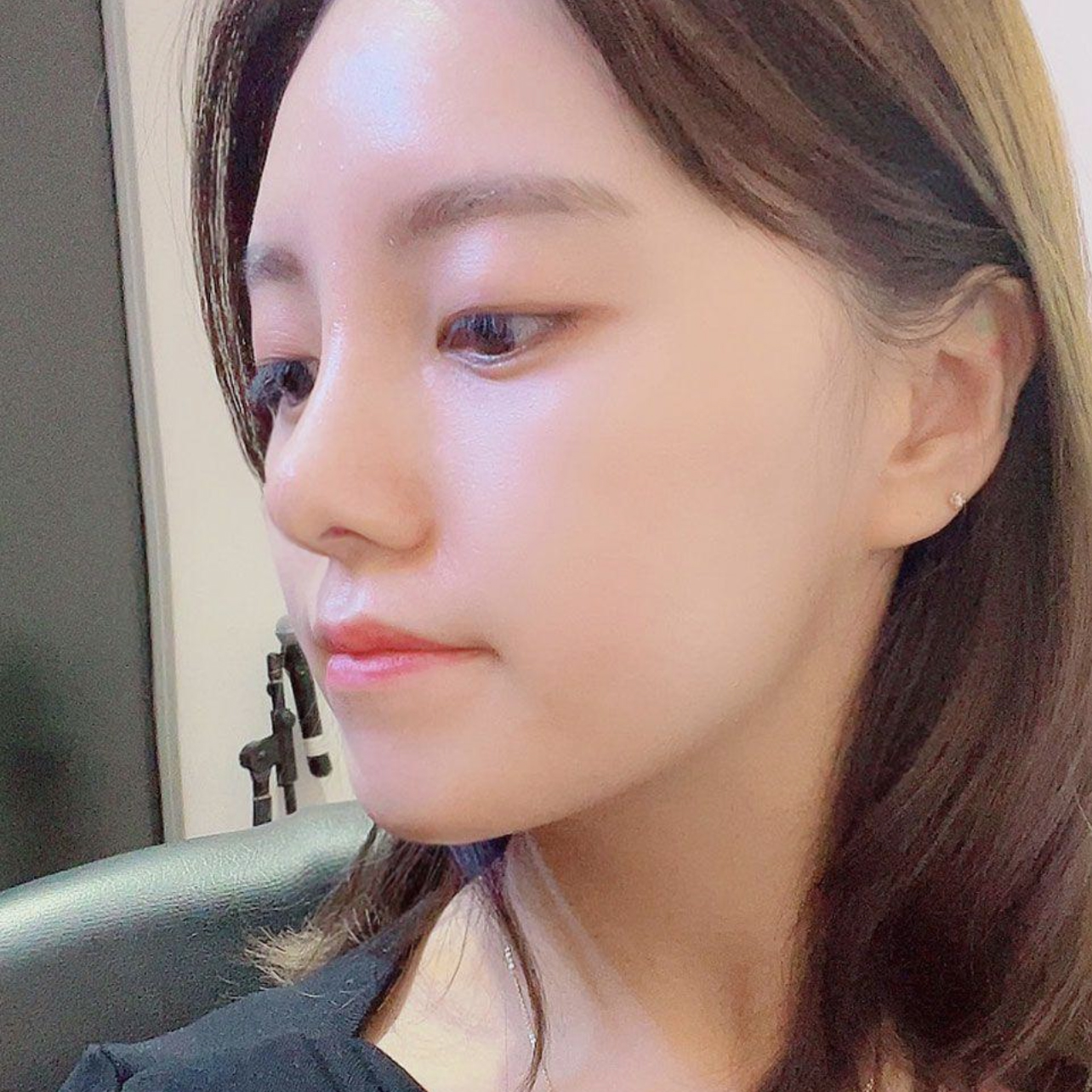 ウィーバース美容外科で鼻の手術をして1ヶ月目です