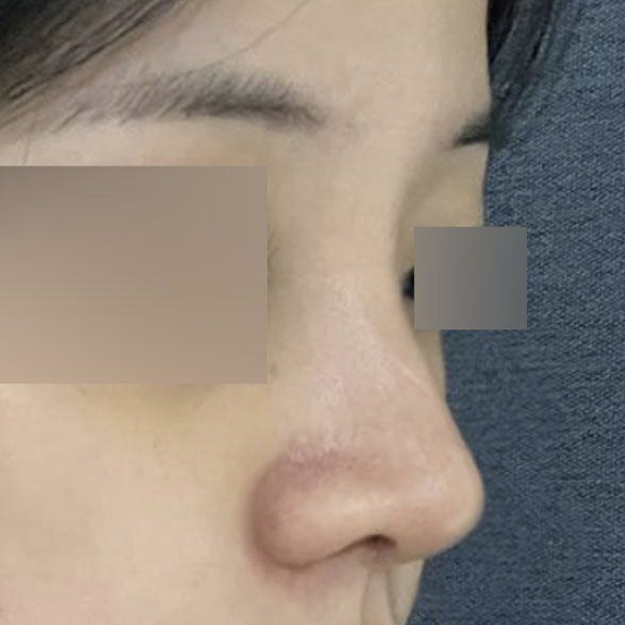 手術して2週間目です