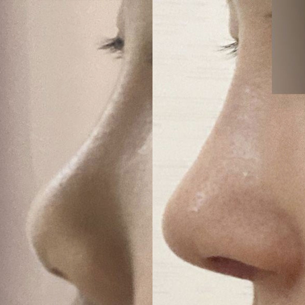 シム・ジョンファン院長に手術を受けてから2週間目です