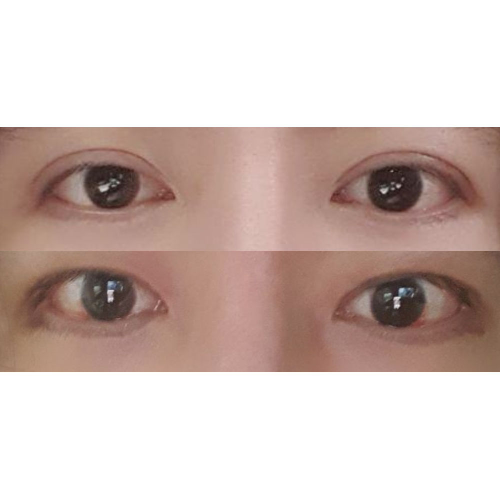 二重ライン縮小再手術＋目つき矯正から10日後（男性）