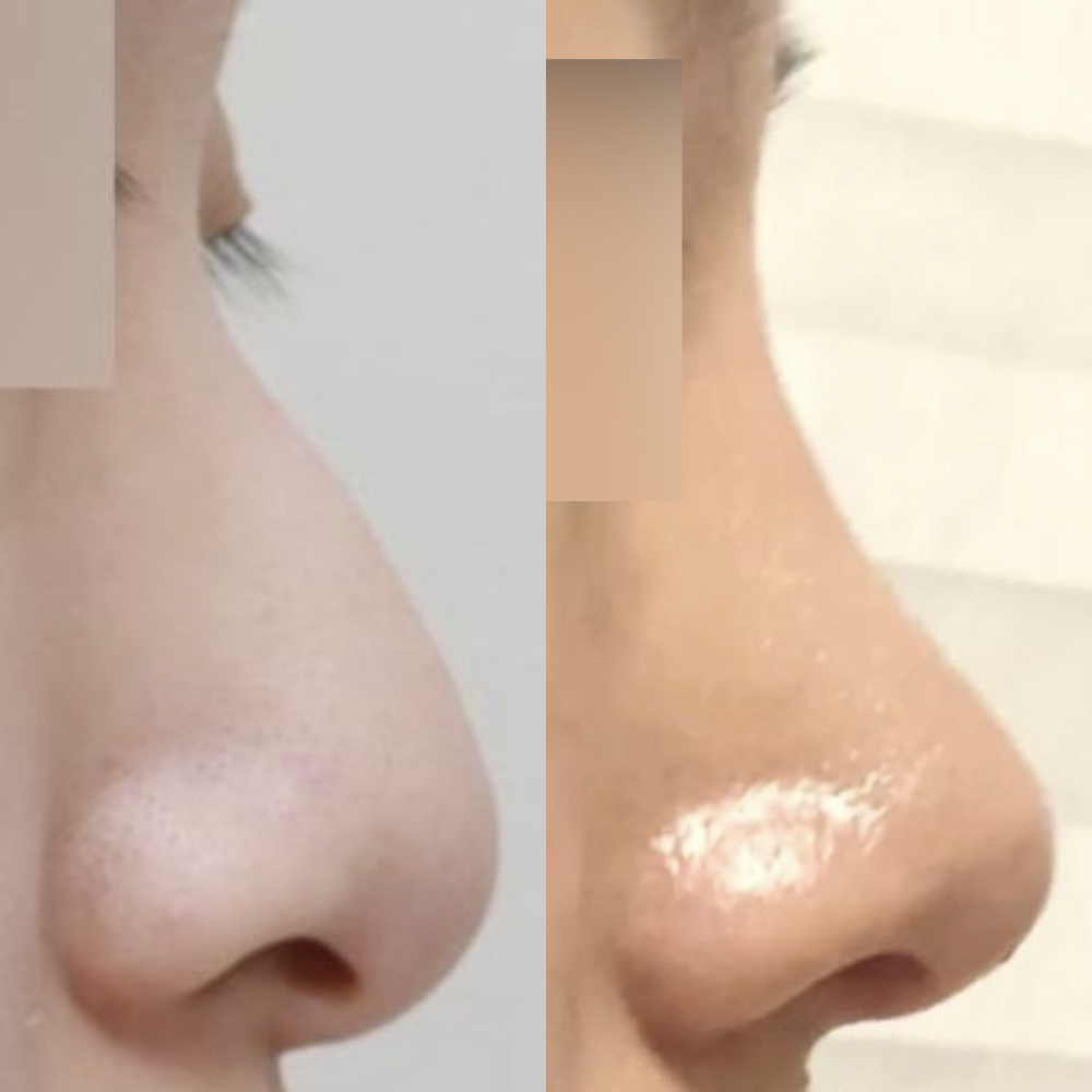 初めての鼻の手術をプロテーゼなしで受けました！