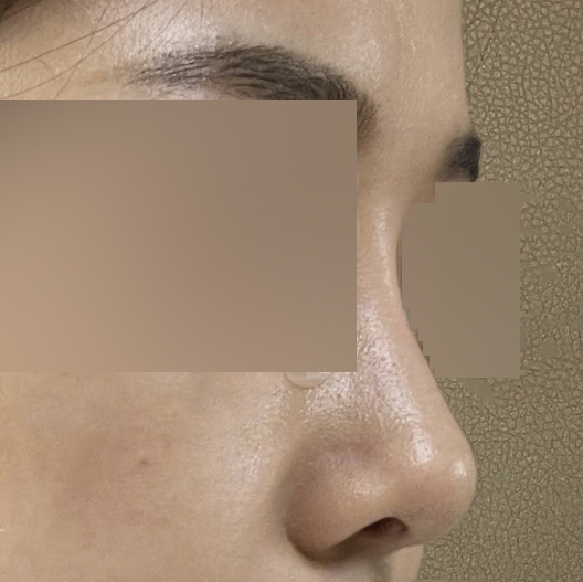 手術から3ヶ月ちょっと経ったレビューです〜