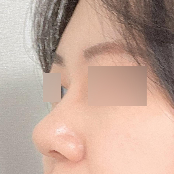 手術3ヶ月目のレビュー