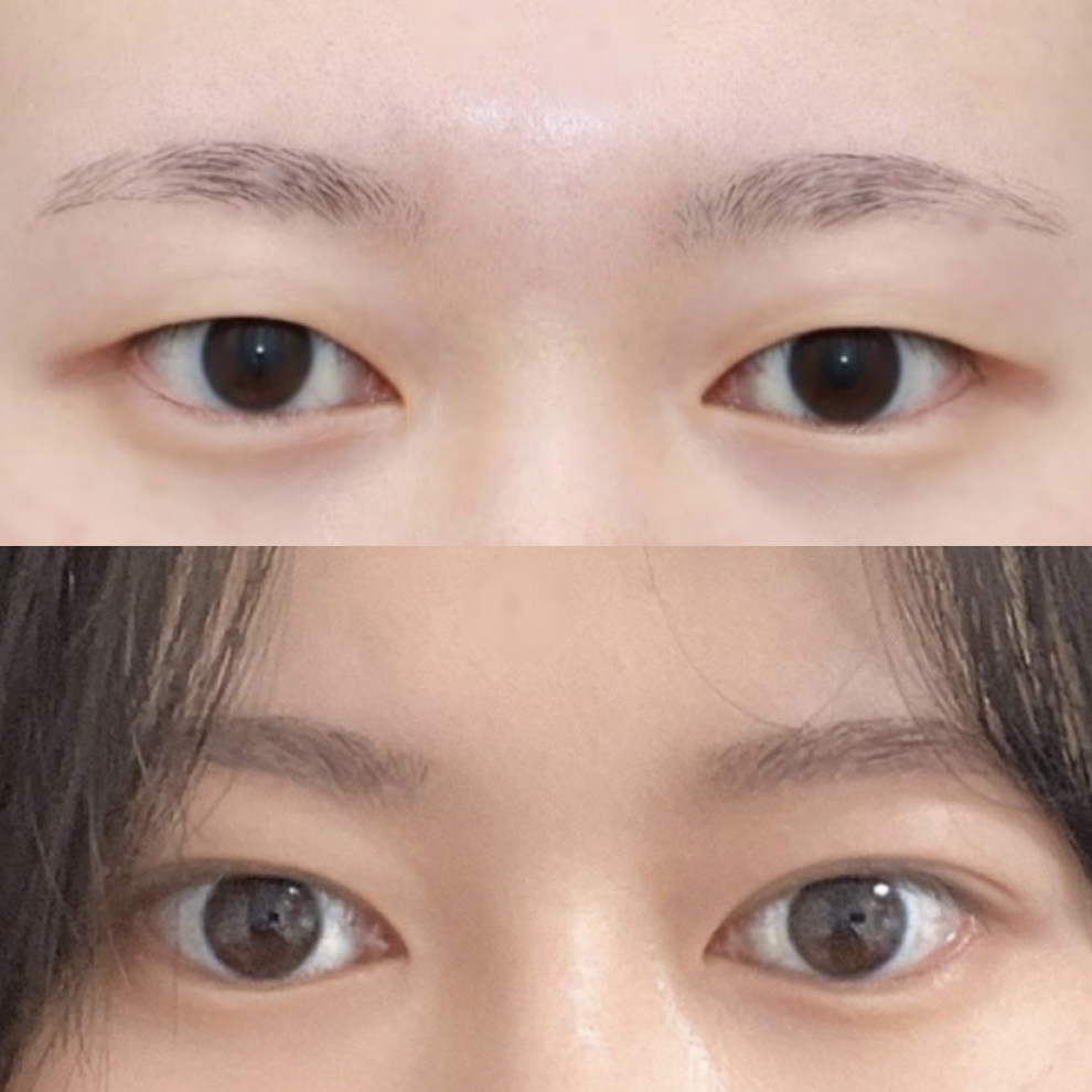 手術後3ヶ月目のレビュー