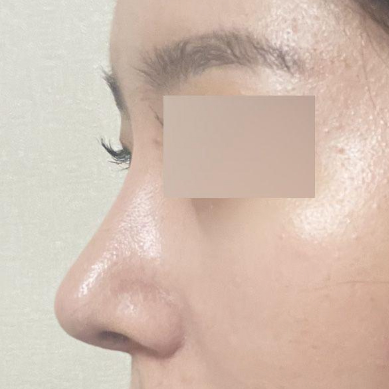 広がった団子鼻の手術から2週間目です
