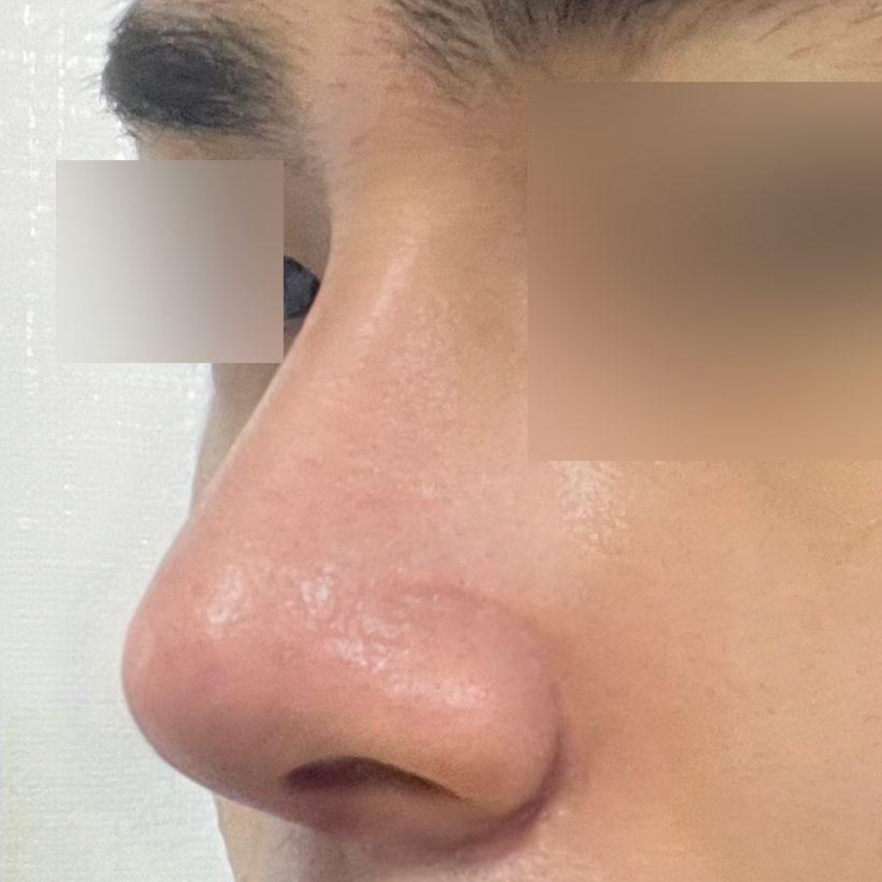 ウィーバース美容外科で手術を受けてから2週間目です。