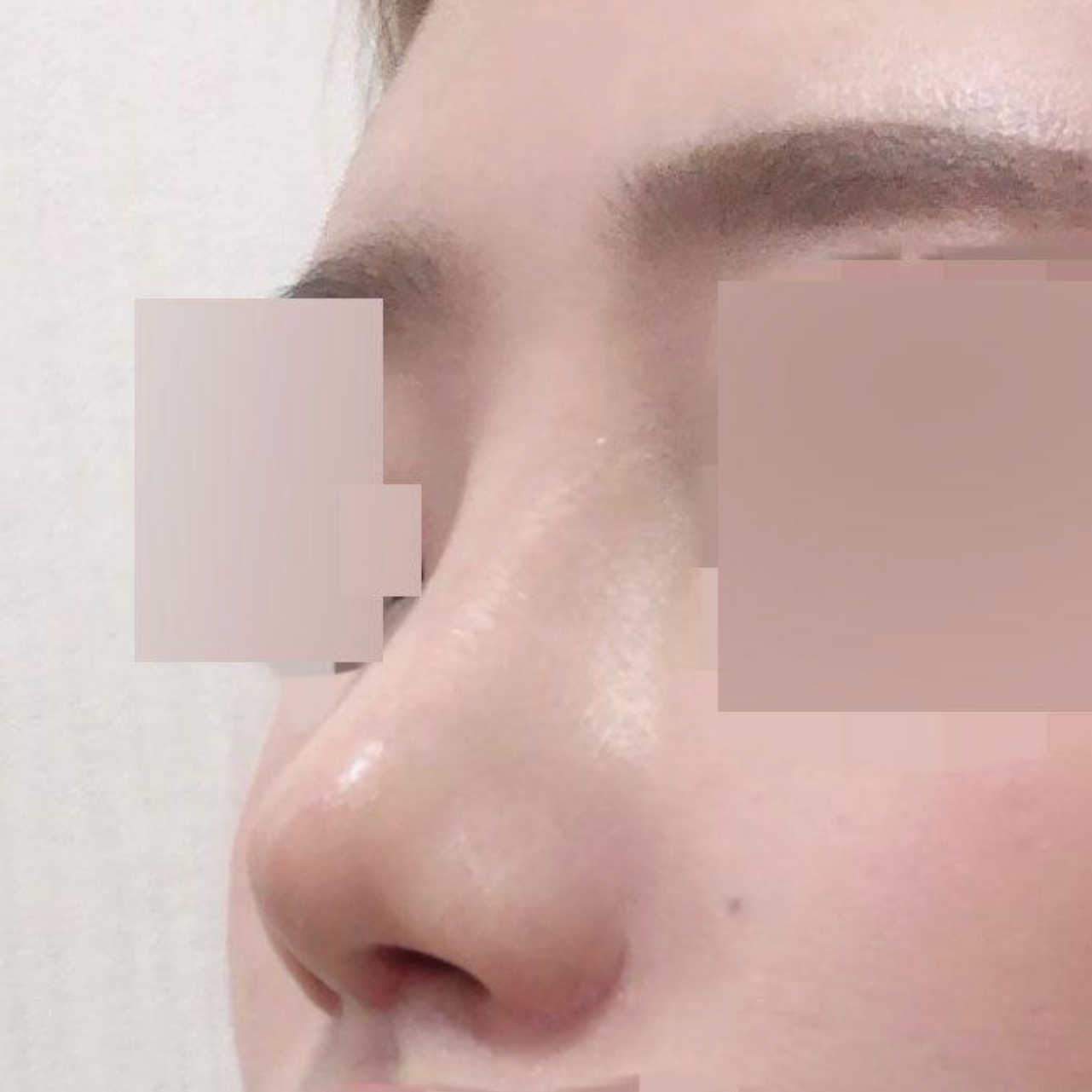 団子鼻の再手術を受けました！