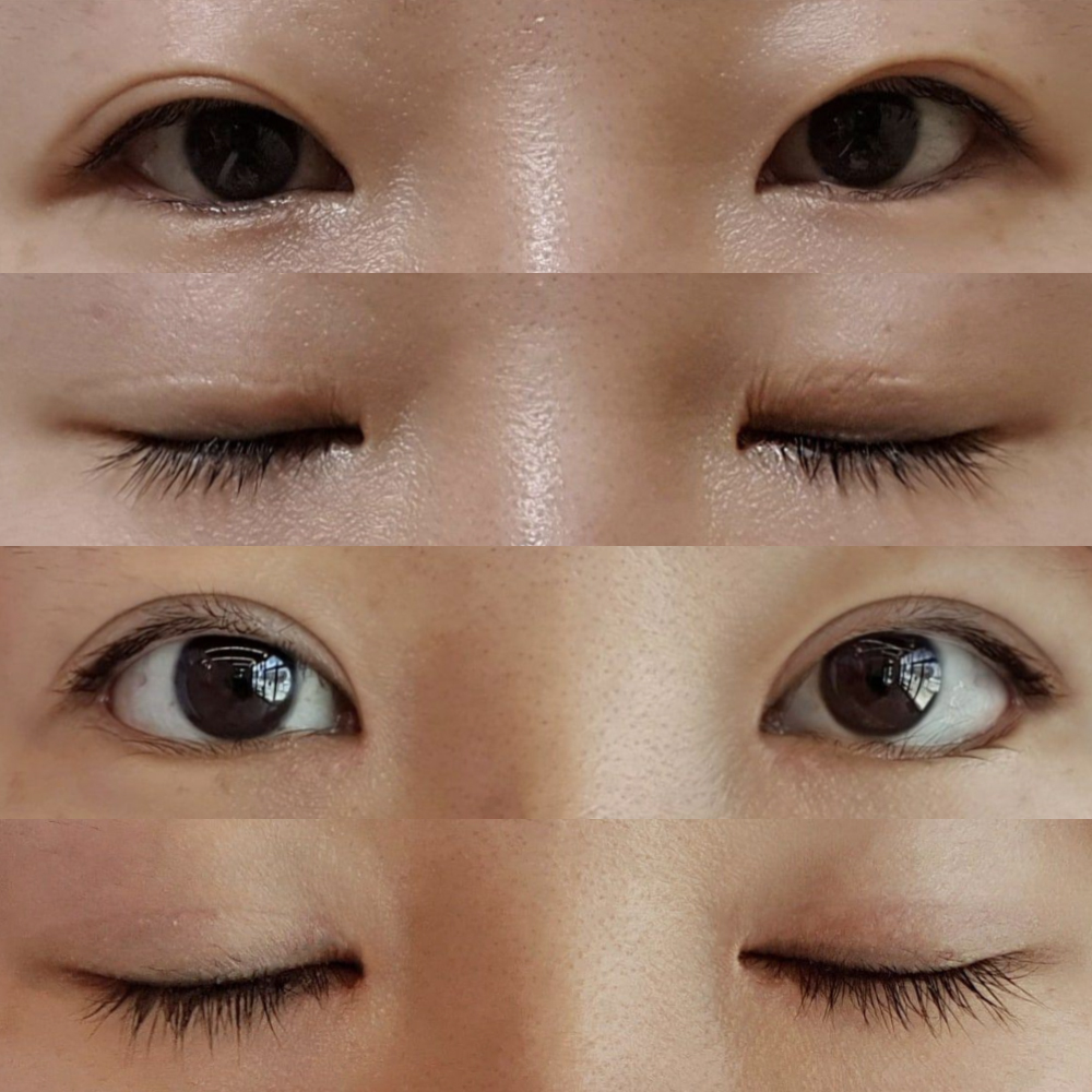 目手術を受けて2ヶ月目です