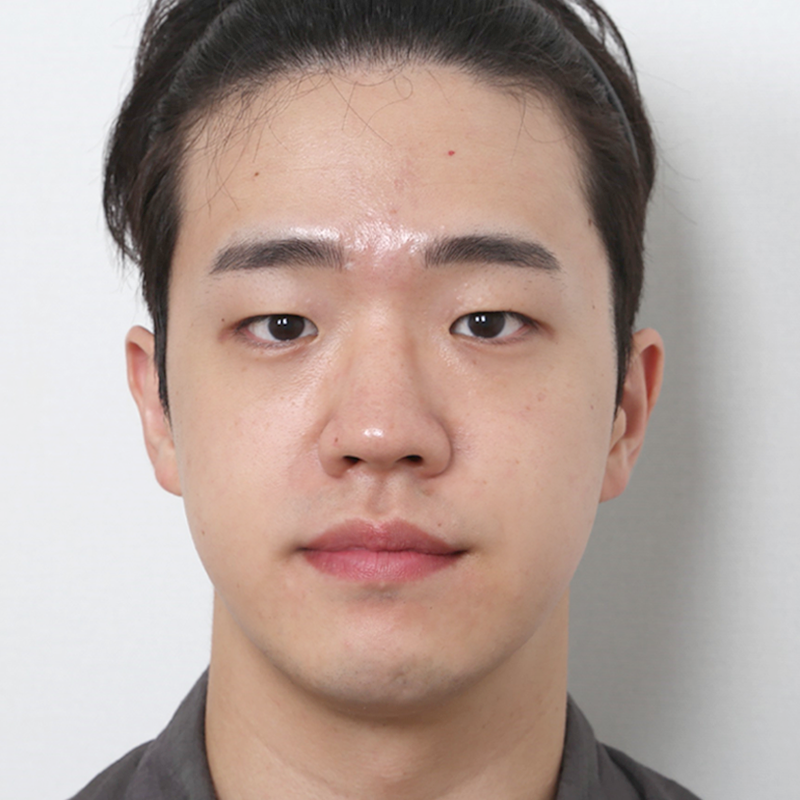 #部分切開 #目つき矯正 #鼻筋（シリコン） #鼻先（自家軟骨）