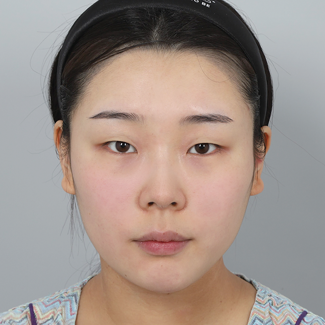 #部分切開 #目頭切開 #目の上の脂肪除去 #鼻筋（シリコン） #鼻先（自家軟骨）