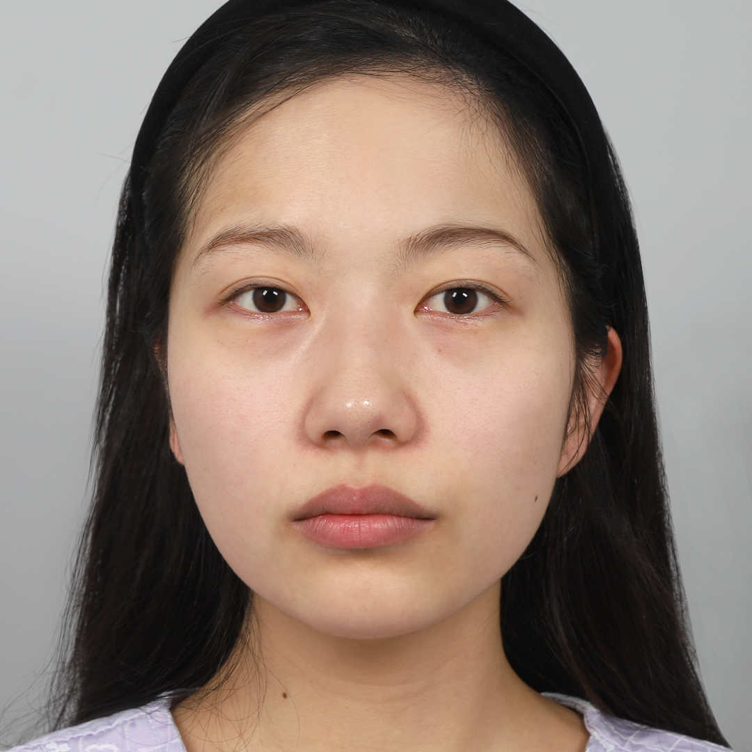 #部分切開 #目頭切開 #プロテーゼなし鼻整形 #鼻先(自家軟骨) #わし鼻矯正 目再手術