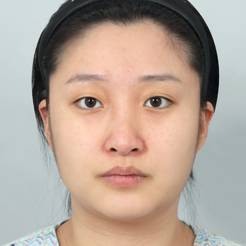 #部分切開 #鼻先(自家軟骨) #プロテーゼなし隆鼻術 #わし鼻矯正 矢印鼻矯正