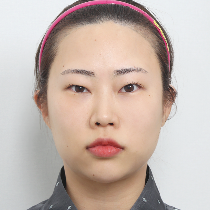 #部分切開 #目頭切開 #目尻切開 #下眼瞼下制 #目の上の脂肪除去 #鼻筋（シリコン） #自家肋軟骨鼻整形