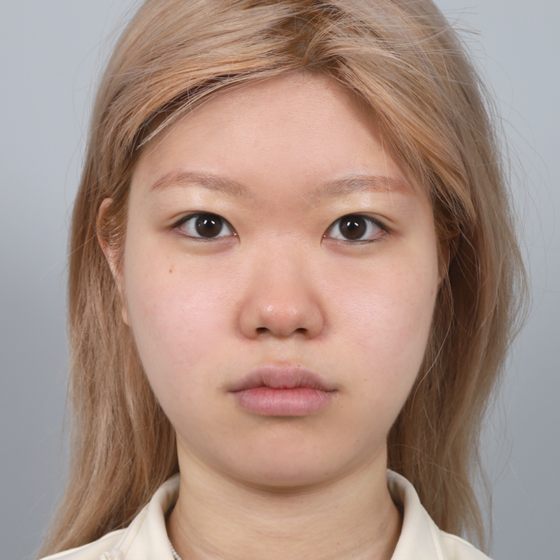 #鼻筋（シリコン）#鼻先（自家軟骨）#団子鼻矯正