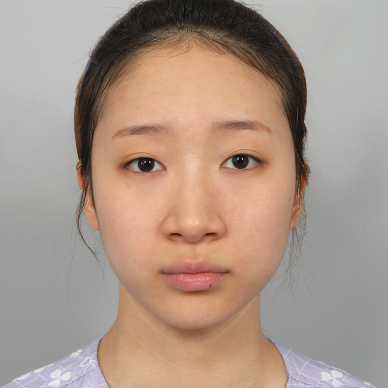 #鼻筋（シリコン）#鼻先（自家軟骨）#小鼻縮小