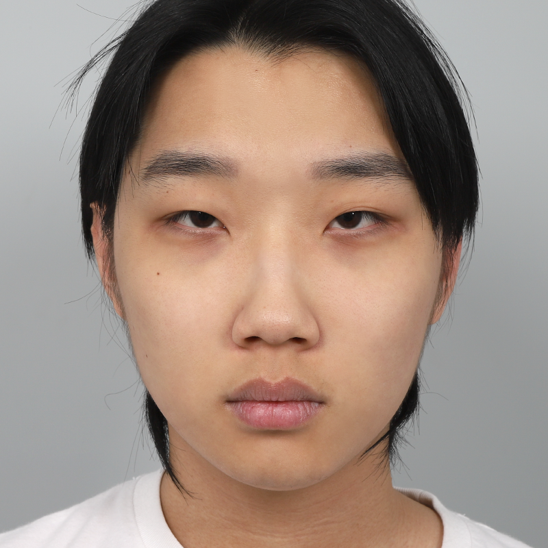 #部分切開 #目つき矯正 #鼻筋(シリコン) #鼻先(自家軟骨) #小鼻縮小