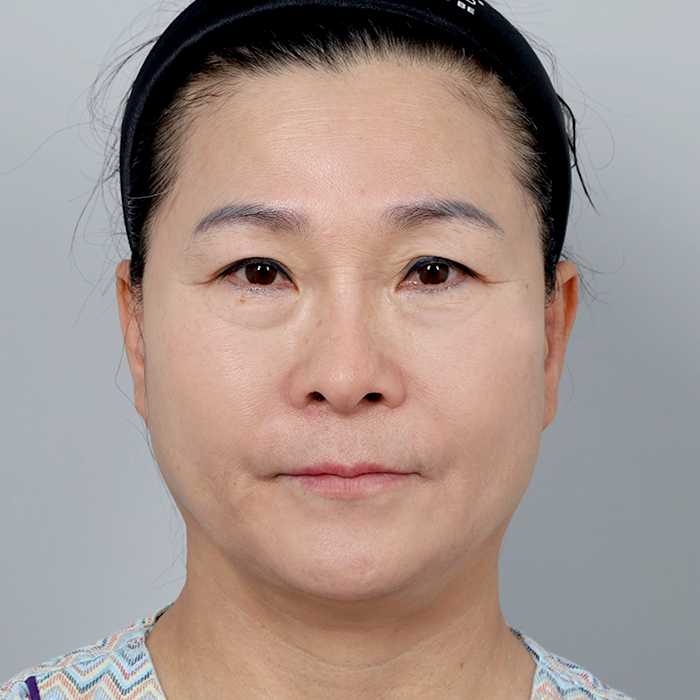 #下眼瞼 #額リフト(エンドタイン)フェイスリフト