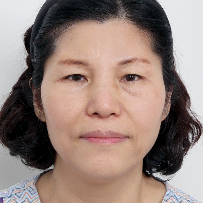 #目の下のたるみ取り #額リフト(エンドタイン)フェイスリフト