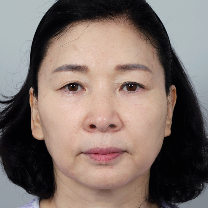 #上眼瞼 #下眼瞼眉下リフトフェイスリフト