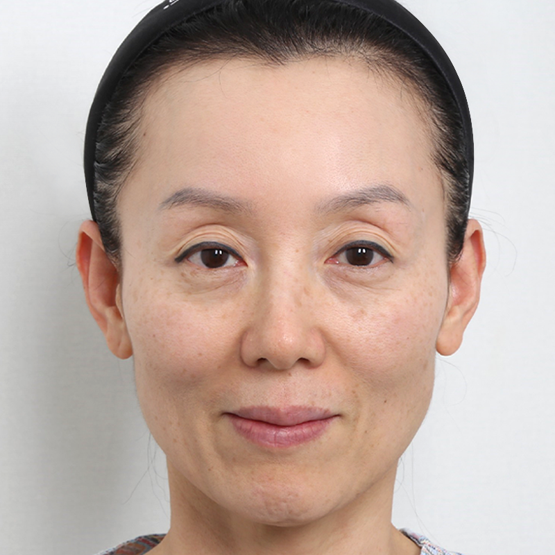 #目の上脂肪移植 #下眼瞼フルフェイス脂肪移植