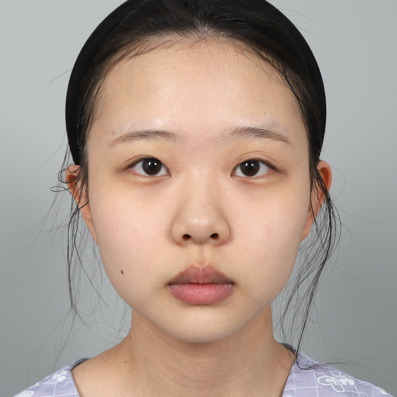 #部分切開 #目頭切開 #癒着剥離 #鼻筋（シリコン） #鼻先（自家軟骨）目の再手術